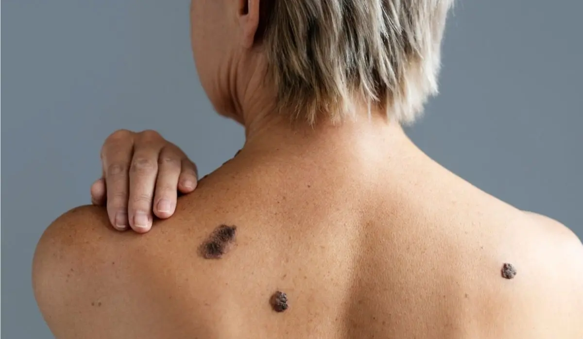 SURGE IN SKIN CANCER CASES OVER PAST 20 YEARS